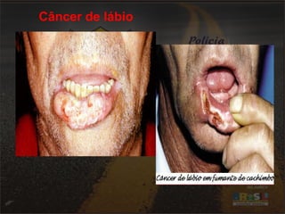 Câncer de lábio 
 