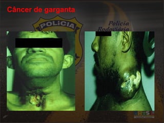 Câncer de garganta 
 