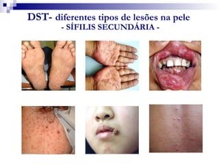 DST- diferentes tipos de lesões na pele
- SÍFILIS SECUNDÁRIA -
 
