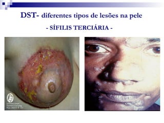 DST- diferentes tipos de lesões na pele
- SÍFILIS TERCIÁRIA -
 