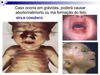 SÍFILIS CONGÊNITA
Caso ocorra em grávidas, poderá causar
aborto/natimorto ou má formação do feto.
 