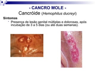 Cancróide (Hemophilus ducreyi)
Sintomas
 Presença de lesão genital múltiplas e dolorosas, após
incubação de 3 a 5 dias (ou até duas semanas).
- CANCRO MOLE -
 