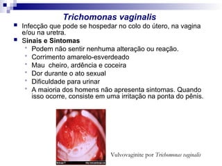 Trichomonas vaginalis
 Infecção que pode se hospedar no colo do útero, na vagina
e/ou na uretra.
 Sinais e Sintomas
 Podem não sentir nenhuma alteração ou reação.
 Corrimento amarelo-esverdeado
 Mau cheiro, ardência e coceira
 Dor durante o ato sexual
 Dificuldade para urinar
 A maioria dos homens não apresenta sintomas. Quando
isso ocorre, consiste em uma irritação na ponta do pênis.
Vulvovaginite por Trichomonas vaginalis
 