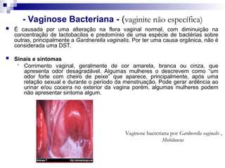 - Vaginose Bacteriana - (vaginite não específica)
 É causada por uma alteração na flora vaginal normal, com diminuição na
concentração de lactobacilos e predomínio de uma espécie de bactérias sobre
outras, principalmente a Gardnerella vaginalis. Por ter uma causa orgânica, não é
considerada uma DST.
 Sinais e sintomas
 Corrimento vaginal, geralmente de cor amarela, branca ou cinza, que
apresenta odor desagradável. Algumas mulheres o descrevem como “um
odor forte com cheiro de peixe” que aparece, principalmente, após uma
relação sexual e durante o período da menstruação. Pode gerar ardência ao
urinar e/ou coceira no exterior da vagina porém, algumas mulheres podem
não apresentar sintoma algum.
Vaginose bacteriana por Gardnerella vaginalis ,
Mobiluncus
 