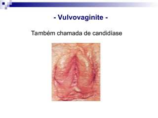 - Vulvovaginite -
Também chamada de candidíase
 
