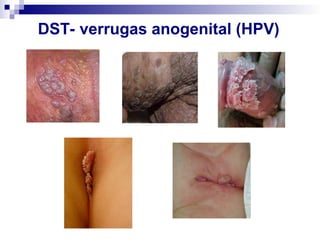 DST- verrugas anogenital (HPV)
 