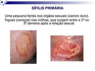 SÍFILIS PRIMÁRIA
Uma pequena ferida nos órgãos sexuais (cancro duro).
Ínguas (caroços) nas virilhas, que surgem entre a 2ª ou
3ª semana após a relação sexual
 