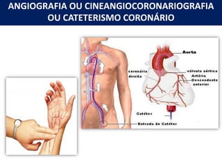 ANGIOGRAFIA OU CINEANGIOCORONARIOGRAFIA
OU CATETERISMO CORONÁRIO