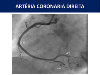ARTÉRIA CORONARIA DIREITA