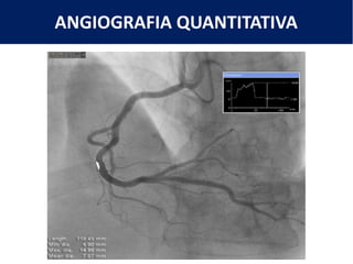 ANGIOGRAFIA QUANTITATIVA
