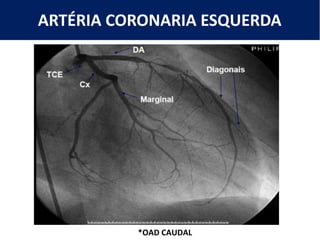 ARTÉRIA CORONARIA ESQUERDA
*OAD CAUDAL