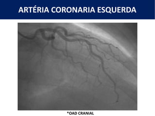 ARTÉRIA CORONARIA ESQUERDA
*OAD CRANIAL
