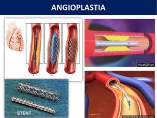 ANGIOPLASTIA
STENT