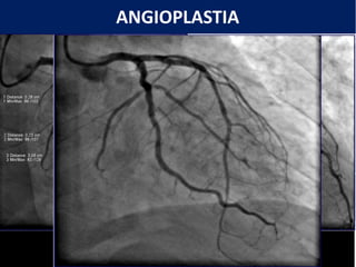 ANGIOPLASTIA