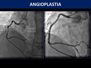 ANGIOPLASTIA