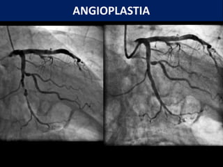ANGIOPLASTIA