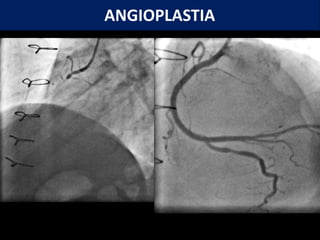 ANGIOPLASTIA