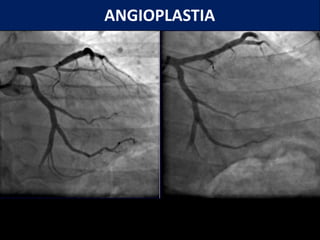 ANGIOPLASTIA