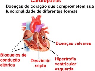 Cardiopatias
  Doenças do coração que comprometem sua
  funcionalidade de diferentes formas




                         Doenças valvares

Bloqueios de
condução     Desvio de   Hipertrofia
elétrica       septo     ventricular
                         esquerda
 