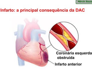 Márcio Souza



Infarto: a principal consequência da DAC




                          Coronária esquerda
                          obstruída
                         Infarto anterior
 