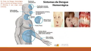 Os Sinais da Dengue Hemorrágica
são os mesmos da Dengue Comum.
A diferença é que surge outros
sintomas.
 