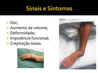  Dor;
 Aumento de volume;
 Deformidade;
 Impotência funcional;
 Crepitação óssea.
 