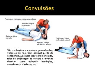 São contrações musculares generalizadas,
violentas ou não, com possível perda da
consciência. As causas são: febre muito alta,
falta de oxigenação do cérebro e diversas
doenças, como epilepsia, meningite,
aneurisma cerebral e outras.
 