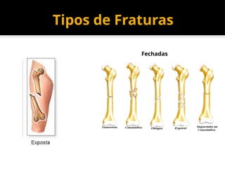 Tipos de Fraturas
Fechadas
 