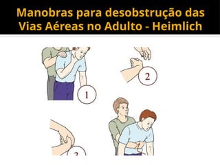 Manobras para desobstrução das
Vias Aéreas no Adulto - Heimlich
 