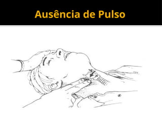 Ausência de Pulso
 