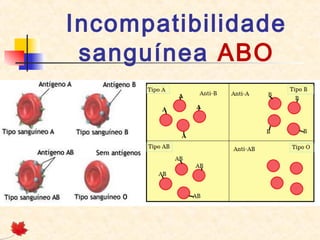 Incompatibilidade
sanguínea ABO

 