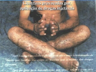 Cicatrizes provocadas por
aplicação de drogas injetáveis
 