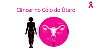 Câncer no Cólo do Útero
 