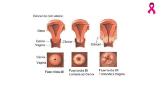 Palestra sobre Cânce do cólo do Útero e Câncer de Mama