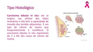 Tipo Histológico
Carcinoma lobular in situ: ele se
origina nas células dos lobos
mamários e não tem a capacidade de
invasão dos tecidos adjacentes. É um
tipo de câncer de mama que
frequentemente é multifocal. O
carcinoma lobular in situ representa
de 2 a 6% dos casos de câncer de
mama.
 