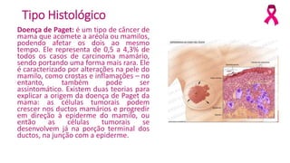 Tipo Histológico
Doença de Paget: é um tipo de câncer de
mama que acomete a aréola ou mamilos,
podendo afetar os dois ao mesmo
tempo. Ele representa de 0,5 a 4,3% de
todos os casos de carcinoma mamário,
sendo portando uma forma mais rara. Ele
é caracterizado por alterações na pele do
mamilo, como crostas e inflamações – no
entanto, também pode ser
assintomático. Existem duas teorias para
explicar a origem da doença de Paget da
mama: as células tumorais podem
crescer nos ductos mamários e progredir
em direção à epiderme do mamilo, ou
então as células tumorais se
desenvolvem já na porção terminal dos
ductos, na junção com a epiderme.
 