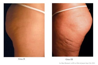 Grau II Grau III
An. Bras. Dermatol. vol.89 no.5 Rio de Janeiro Sept./Oct. 2014
 