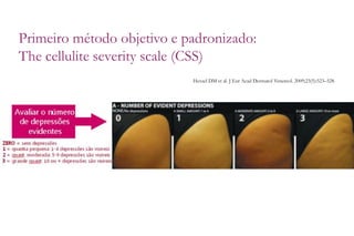 Primeiro método objetivo e padronizado:
The cellulite severity scale (CSS)
Hexsel DM et al. J Eur Acad Dermatol Venereol. 2009;23(5):523–528
 