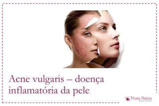 Acne vulgaris – doença
inflamatória da pele
 