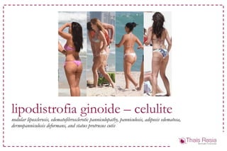lipodistrofia ginoide – celulite
nodular liposclerosis, edematofibrosclerotic panniculopathy, panniculosis, adiposis edematosa,
dermopanniculosis deformans, and status protrusus cutis
 