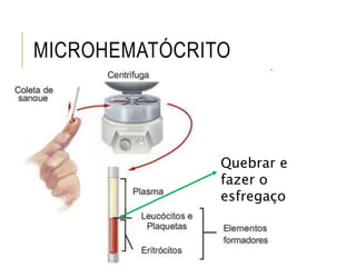 MICROHEMATÓCRITO
Quebrar e
fazer o
esfregaço
 
