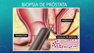 BIOPSIA DE PRÓSTATA
 