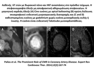 Ασθενής 67 ετών με θωρακικό πόνο και ΗΚΓ ανασπάσεις στο πρόσθιο τοίχωμα. Η
στεφανιογραφία έδειξε μη αποφρακτική αθηρωμάτωση στεφανιαίων. Η
μαγνητική καρδιάς έδειξε (A) Cine εικόνες με apical ballooning (B) πρώτη διέλευση
σκιαγραφικού ενδεικτική μικροαγγειακής διαταραχής και (C and D)
καθυστερημένες εικόνες με gadolinium χωρίς εικόνα μυοκαρδιακής ουλής ή
ίνωσης. Η εικόνα είναι ενδεικτική Takotsubo μυοκαρδιοπάθειας.
Palios et al. The Prominent Role of CMR in Coronary Artery Disease. Expert Rev
Cardiovasc Ther. 2014;12(2):167-74
 