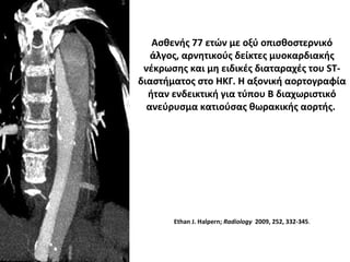 Ασθενής 77 ετών με οξύ οπισθοστερνικό
άλγος, αρνητικούς δείκτες μυοκαρδιακής
νέκρωσης και μη ειδικές διαταραχές του ST-
διαστήματος στο ΗΚΓ. Η αξονική αορτογραφία
ήταν ενδεικτική για τύπου Β διαχωριστικό
ανεύρυσμα κατιούσας θωρακικής αορτής.
Ethan J. Halpern; Radiology 2009, 252, 332-345.
 