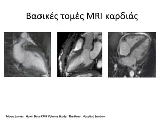 Βασικές τομές MRI καρδιάς
Moon, James. How I Do a CMR Volume Study. The Heart Hospital, London.
 
