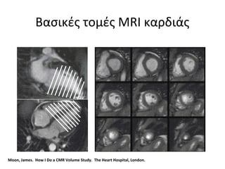 Βασικές τομές MRI καρδιάς
Moon, James. How I Do a CMR Volume Study. The Heart Hospital, London.
 
