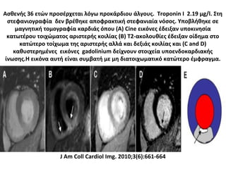 Ασθενής 36 ετών προσέρχεται λόγω προκάρδιου άλγους. Troponin I 2.19 μg/l. Στη
στεφανιογραφία δεν βρέθηκε αποφρακτική στεφανιαία νόσος. Υποβλήθηκε σε
μαγνητική τομογραφία καρδιάς όπου (A) Cine εικόνες έδειξαν υποκινησία
κατωτέρου τοιχώματος αριστερής κοιλίας (B) T2-ακολουθίες έδειξαν οίδημα στο
κατώτερο τοίχωμα της αριστερής αλλά και δεξιάς κοιλίας και (C and D)
καθυστερημένες εικόνες gadolinium δείχνουν στοιχεία υποενδοκαρδιακής
ίνωσης.Η εικόνα αυτή είναι συμβατή με μη διατοιχωματικό κατώτερο έμφραγμα.
J Am Coll Cardiol Img. 2010;3(6):661-664
 