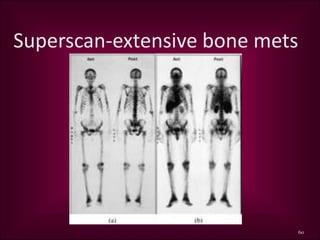 Superscan Bone PALLIATIVE CARE | PPT