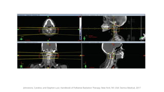 Guide to Palliative Radiotherapy in Advanced Cancer Care | PPTX