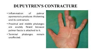 DUPUYTREN’S CONTRACTURE
• Inflammation of palmar
aponeurosis produces thickening
and its contracture.
• Proximal and middle phalanges
are acutely flexed because
palmar fascia is attached to it.
• Terminal phalanges remain
unaffected.
 